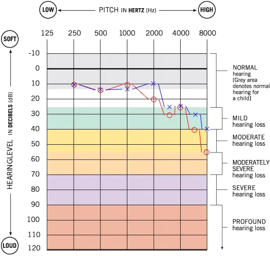 Navigating-Single-Sided-Deafness-with-Contralateral-Hearing-Loss-and-Hearing-Aid-A-Case-Study-of-Mr.-DennisBy-Ashley-Tilahun-Au.D.-CCC-A-FAAA Linner