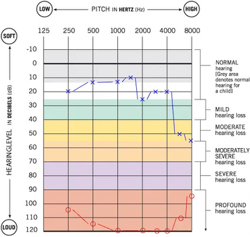 Navigating-Single-Sided-Deafness-with-Contralateral-Hearing-Loss-and-Hearing-Aid-A-Case-Study-of-Mr.-Dennis Linner