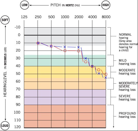 Navigating-Hearing-Loss-A-Case-Study-on-the-Impact-of-Transient-Ischemic-Attacks-on-Auditory-Perception-and-Treatment Linner